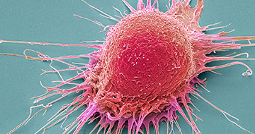 New Advancements in Preclinical Prostate Cancer PDX Models