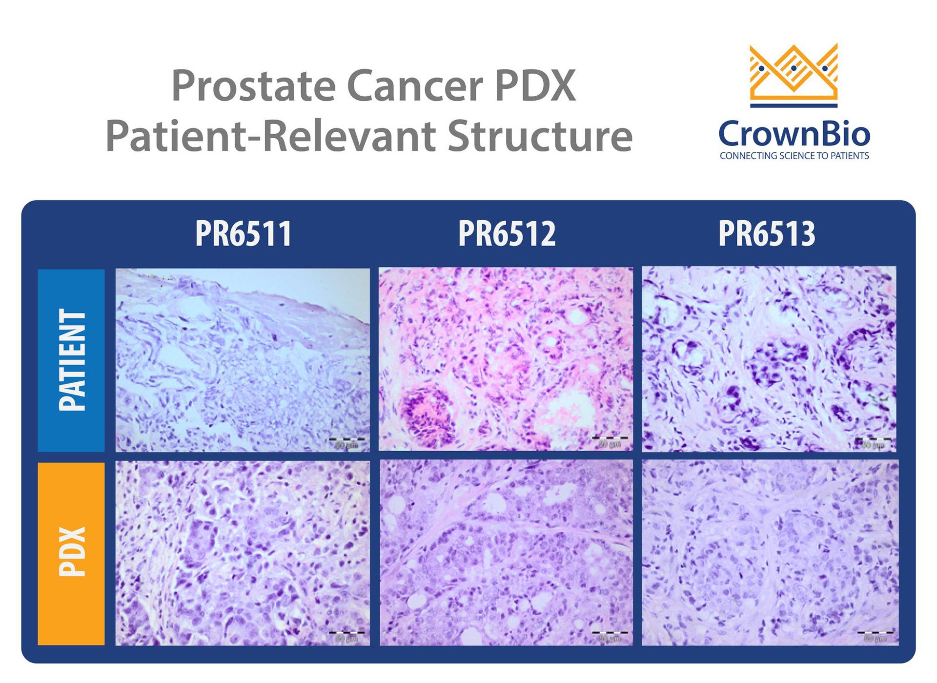 Prostate Cancer Patient-Derived Xenograft (PDX) Models