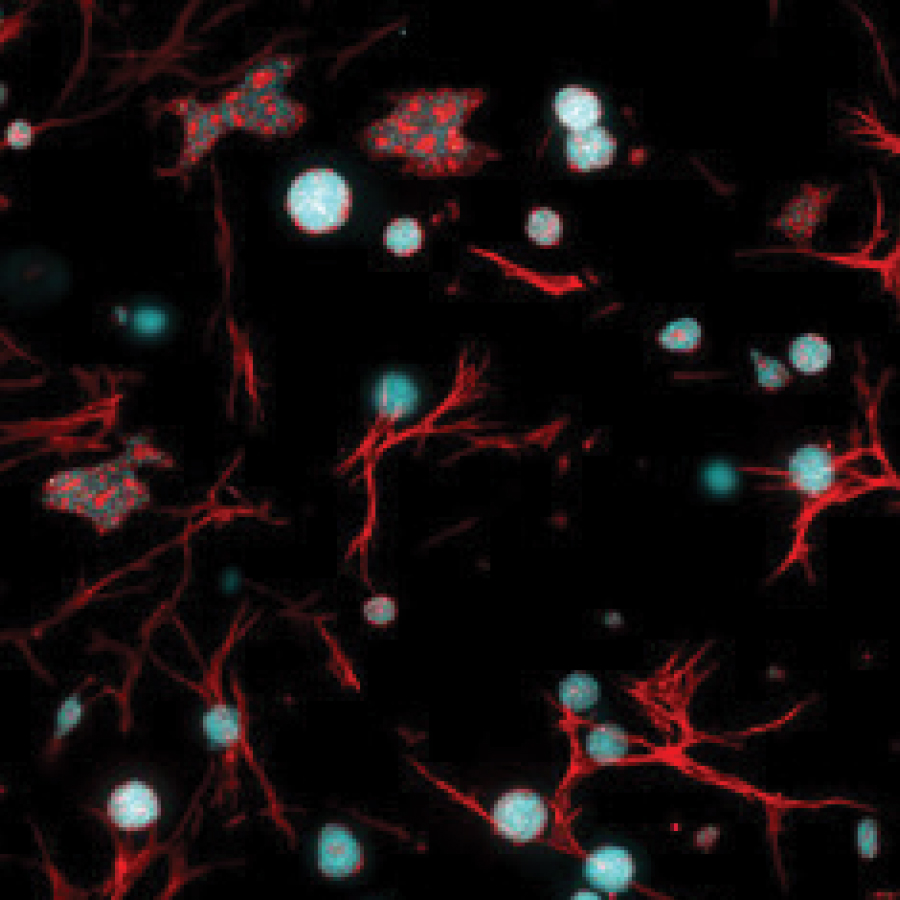 Mini-tumors: Pre-clinical HCI assays to screen anti-cancer drugs in the context of organoids, cancer-associated fibroblasts and immune cells