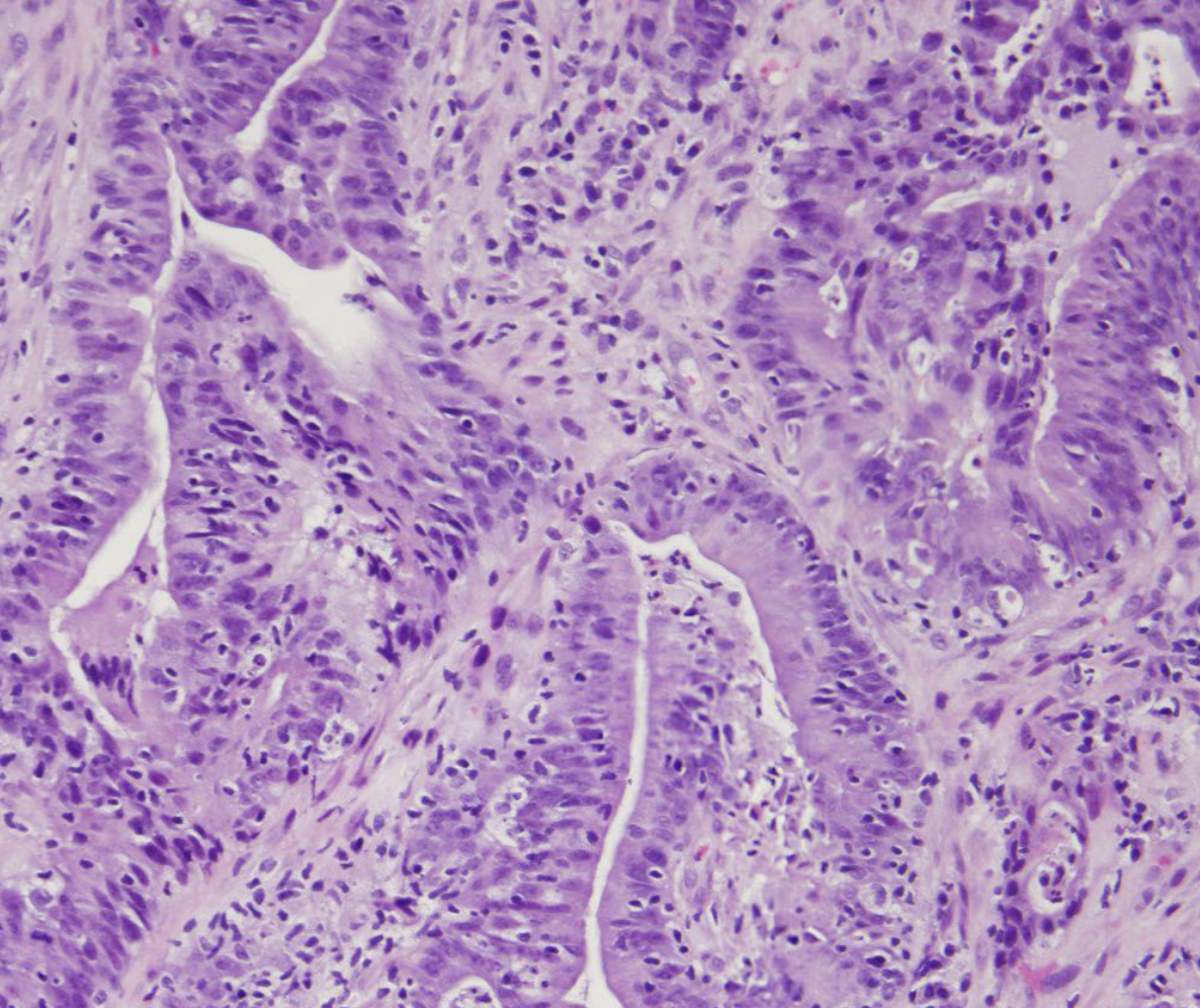 The Importance of Tissue Quality for Personalized Medicine