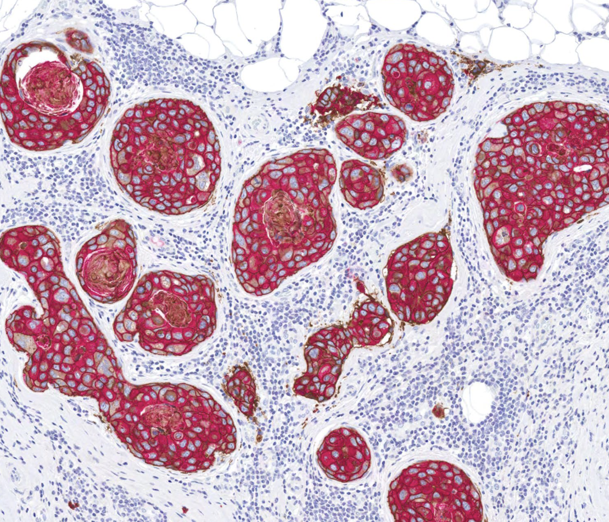 Immunohistochemical Detection of Phospho-HER-3 in Human Breast Cancer
